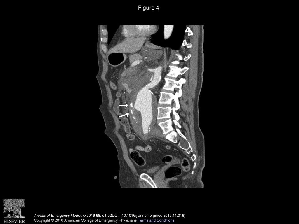 Figure 4 Correlative multidetector CT image at the same plane as in Figure 2, confirming the presence of calcifications (arrows) within the thrombus.