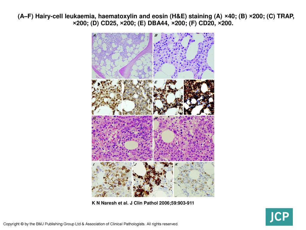 (A–F) Hairy-cell leukaemia, haematoxylin and eosin (H&E) staining (A) ×40; (B) ×200; (C) TRAP, ×200; (D) CD25, ×200; (E) DBA44, ×200; (F) CD20, ×200.