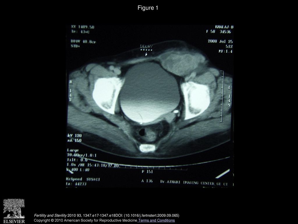 Figure 1 Abdominopelvic computed tomography scan showing a tumor in the abdominal wall without invasion of intra-abdominal organs.