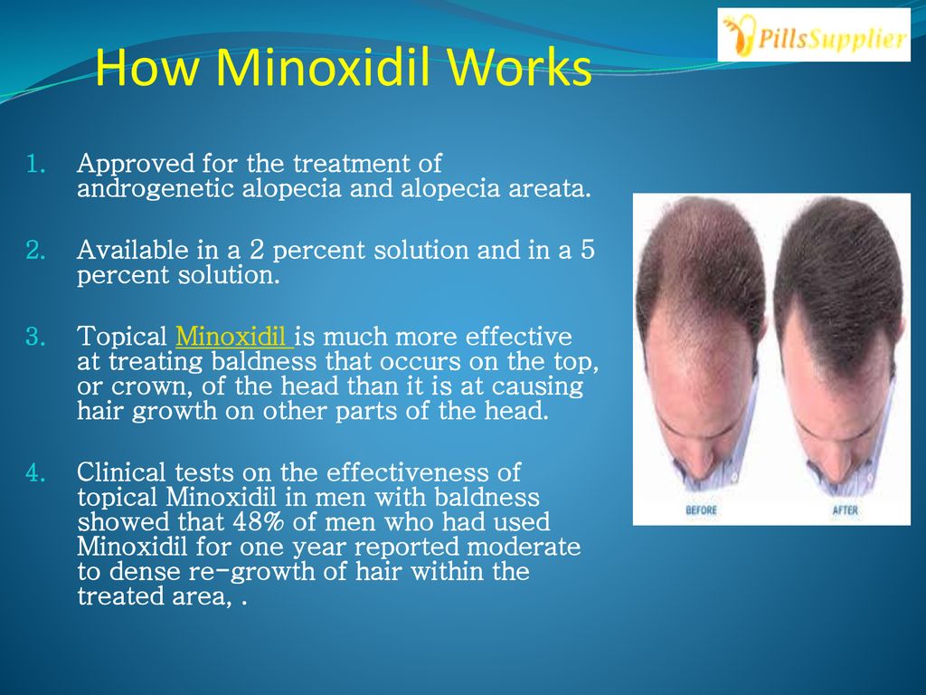 Buy Minoxidil Hair loss Medicine Online - ppt download