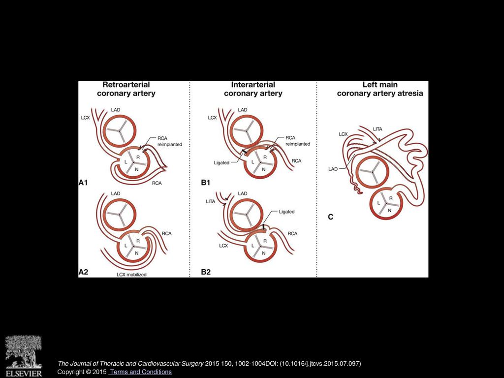 Schematic presentation of the coronary artery anomalies encountered during Ross operation.