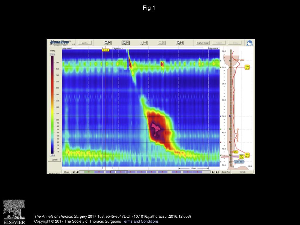 an-involuntary-and-unexpected-treatment-of-nutcracker-esophagus-ppt