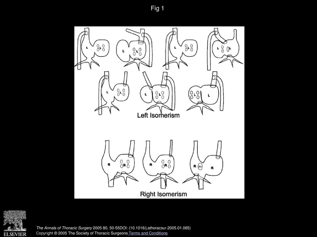 Fig 1 Various venous drainage patterns of the patients: left isomerism = 7, right isomerism = 3. (PV = pulmonary vein.)