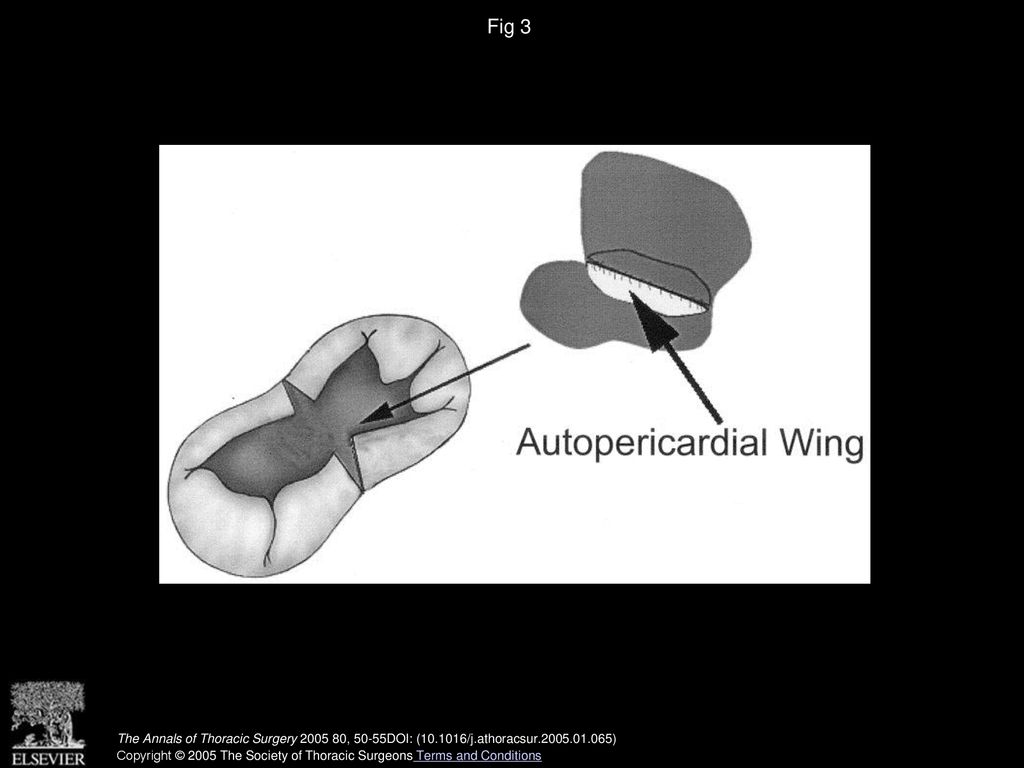 Fig 3 The method for atrioventricular septal defect repair with autopericardial winged patch (Kawashima).