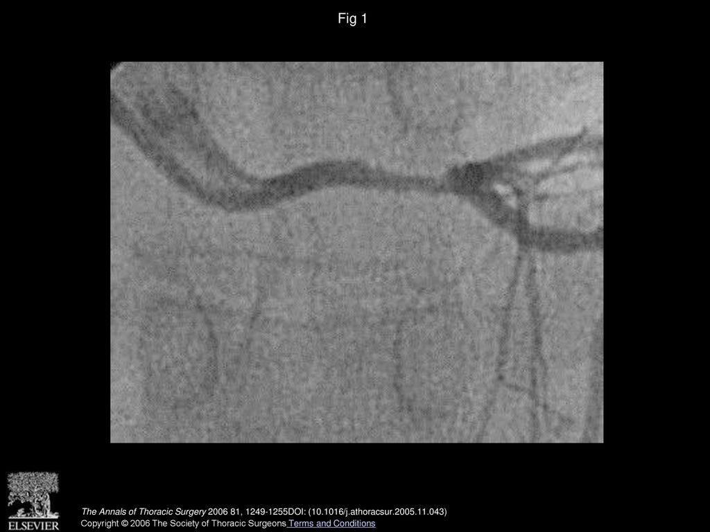 Fig 1 Preoperative angiographic image of a circular left main coronary artery stenosis.