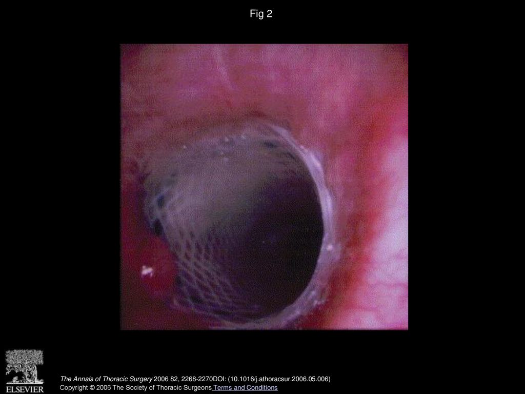 Fig 2 Proximal left main stem bronchus widely patent with expandable silastic stent after 6 months.