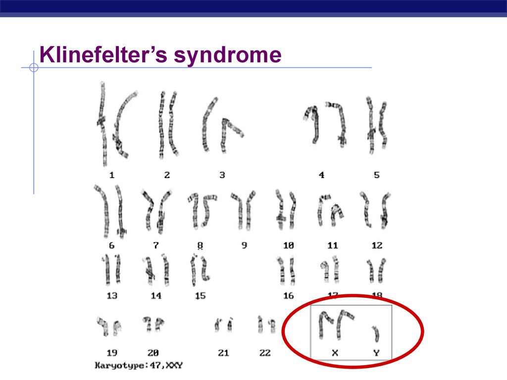 Синдром клайнфельтера схема