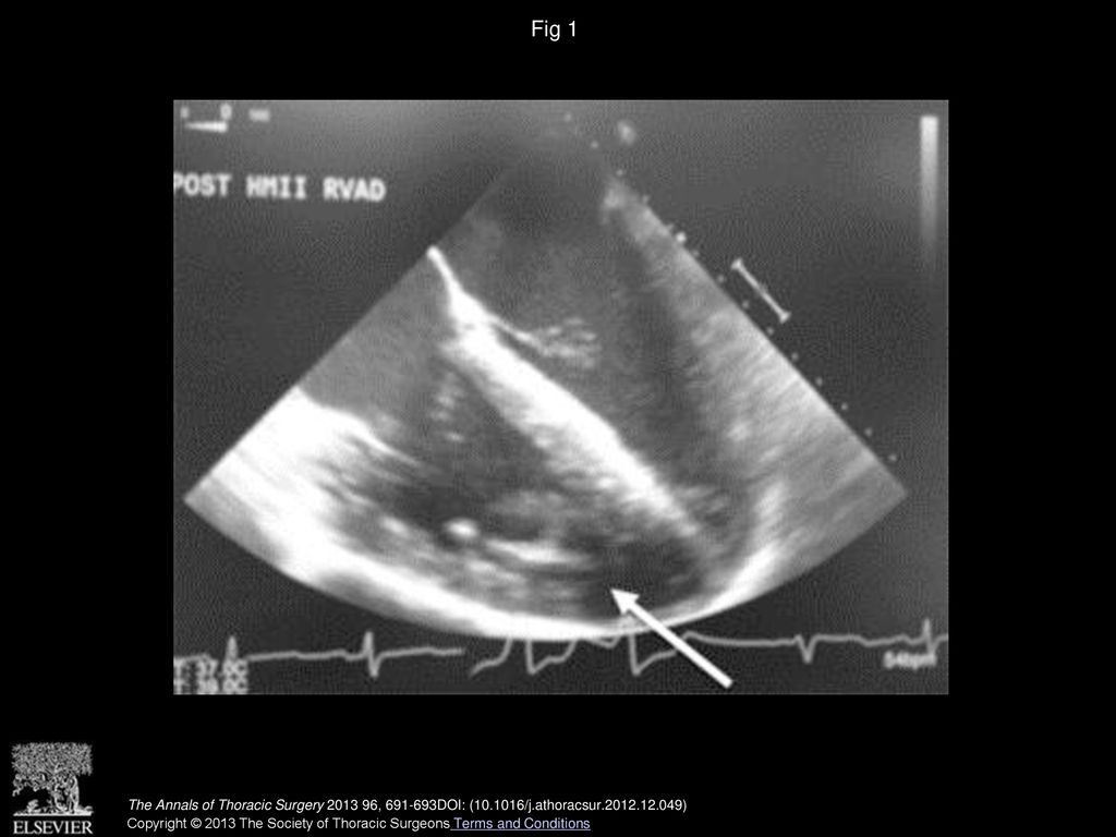 Fig 1 Intraoperative transesophageal echocardiogram revealing position of right ventricular cannula (arrow).