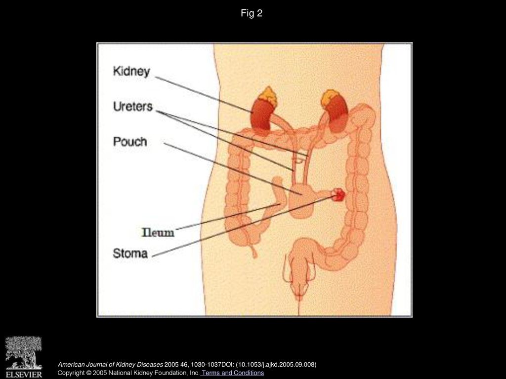 Fig 2 Continent urinary diversion. (Modified from CancerHelp UK; available at: