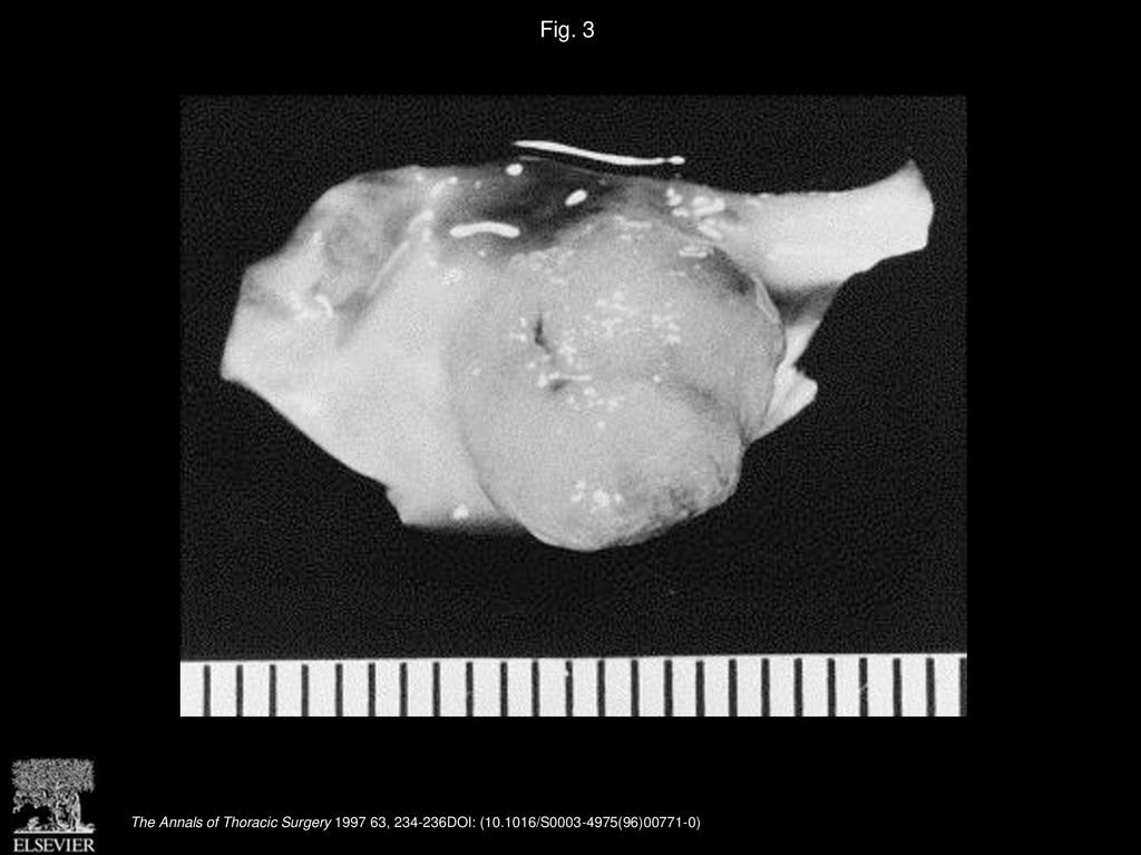 Fig. 3 Specimen of exised myxoma of the aortic valve.