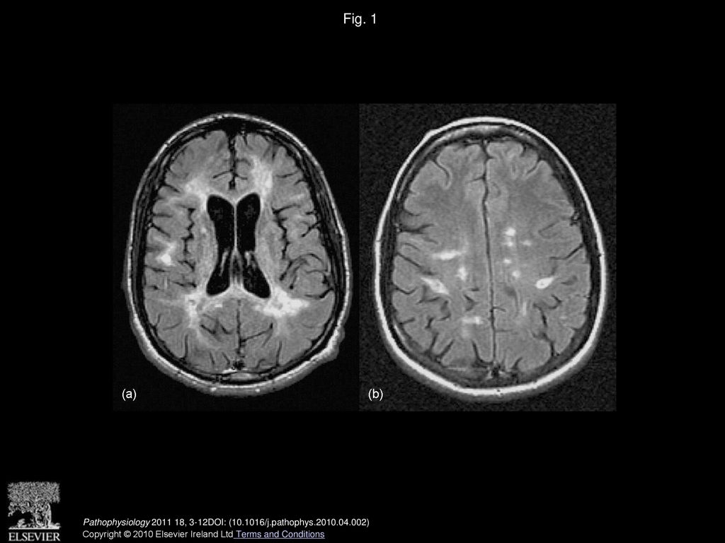 Multiple sclerosis and cerebral endothelial dysfunction: Mechanisms ...