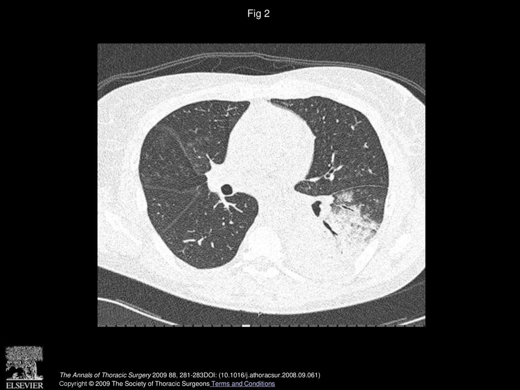 Fig 2 Preoperative computed tomographic scan demonstrating air-space consolidation of the left lower lobe.