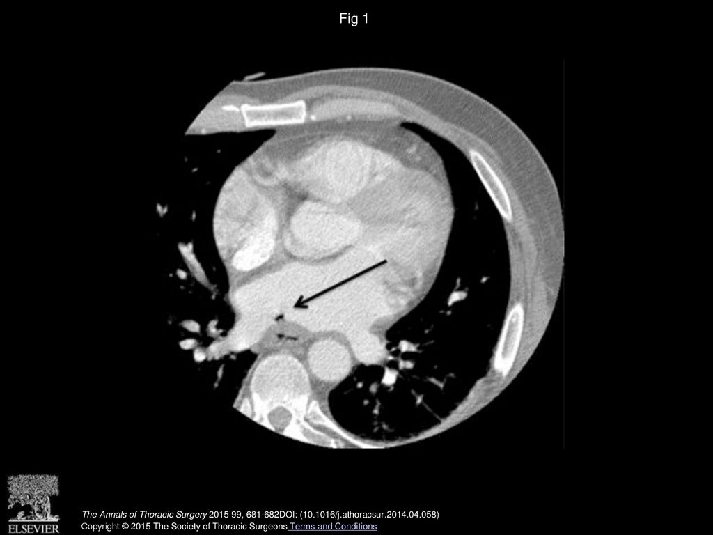 Fig 1 Computed tomography scan image showing air in the posterior left atrium (arrow).