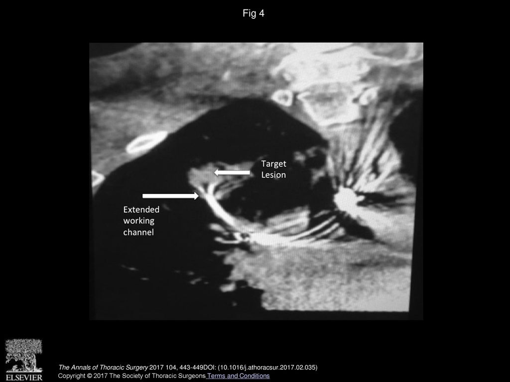 Fig 4 Cone beam computed tomography imaging demonstrates the extended working channel in the target lesion.