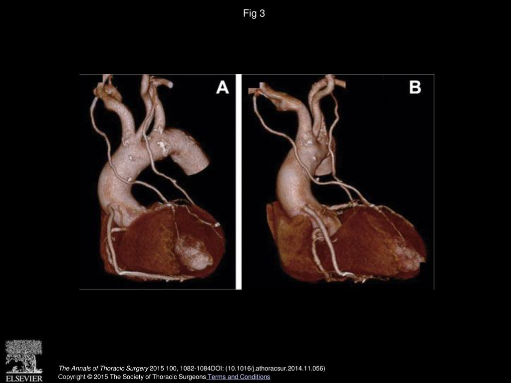 Fig 3 Postoperative computed tomography angiography. (A, B) The bilateral in situ internal thoracic arteries and saphenous vein graft were patent.