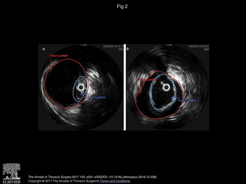 Fig 2 Intraoperative intravascular ultrasonography used to measure and evaluate the true and false lumens (A) before and (B) after stent deployment.