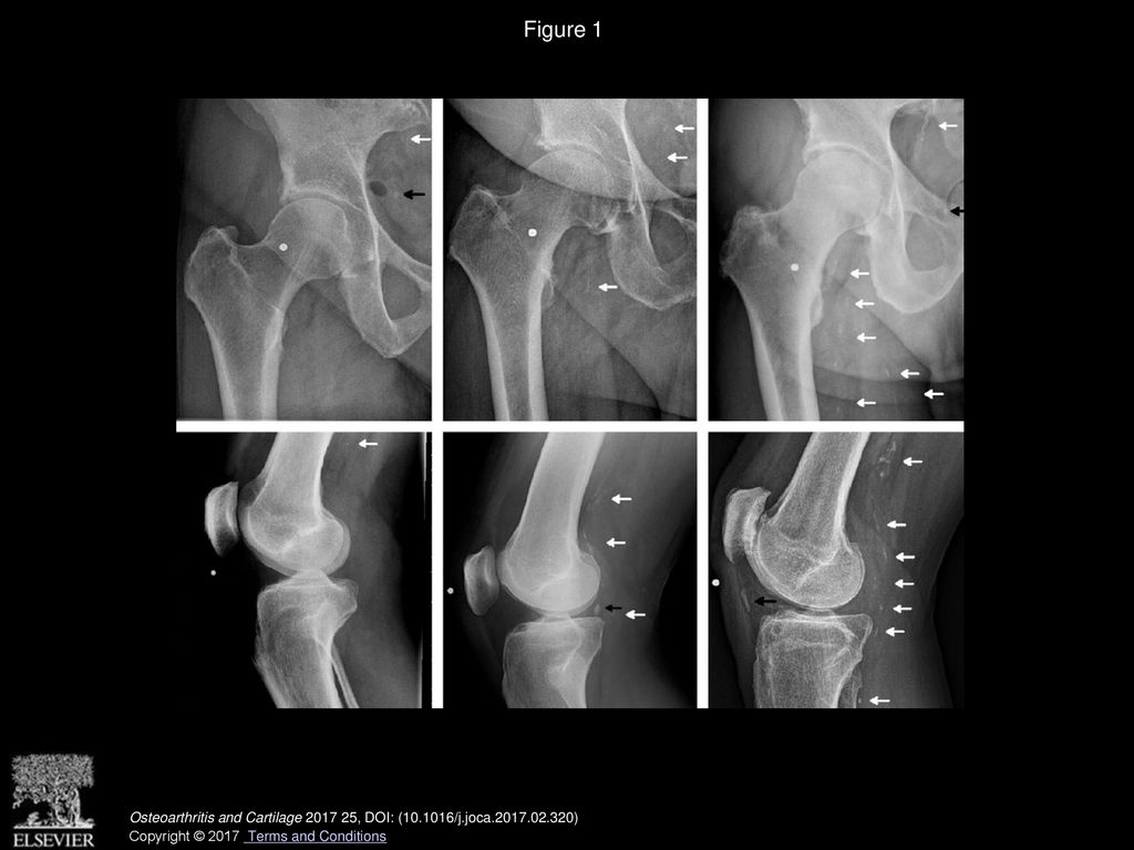 A Sex Specific Association Between The Development Of Radiographic Osteoarthritis Of The Hip Or 7477