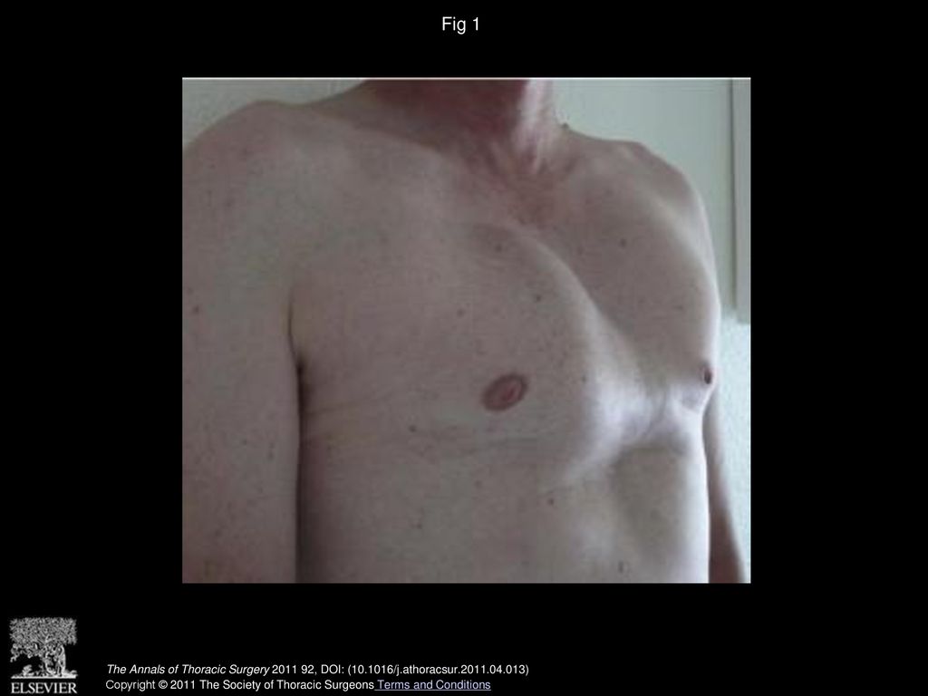 Fig 1 The Annals of Thoracic Surgery , DOI: ( /j.athoracsur )
