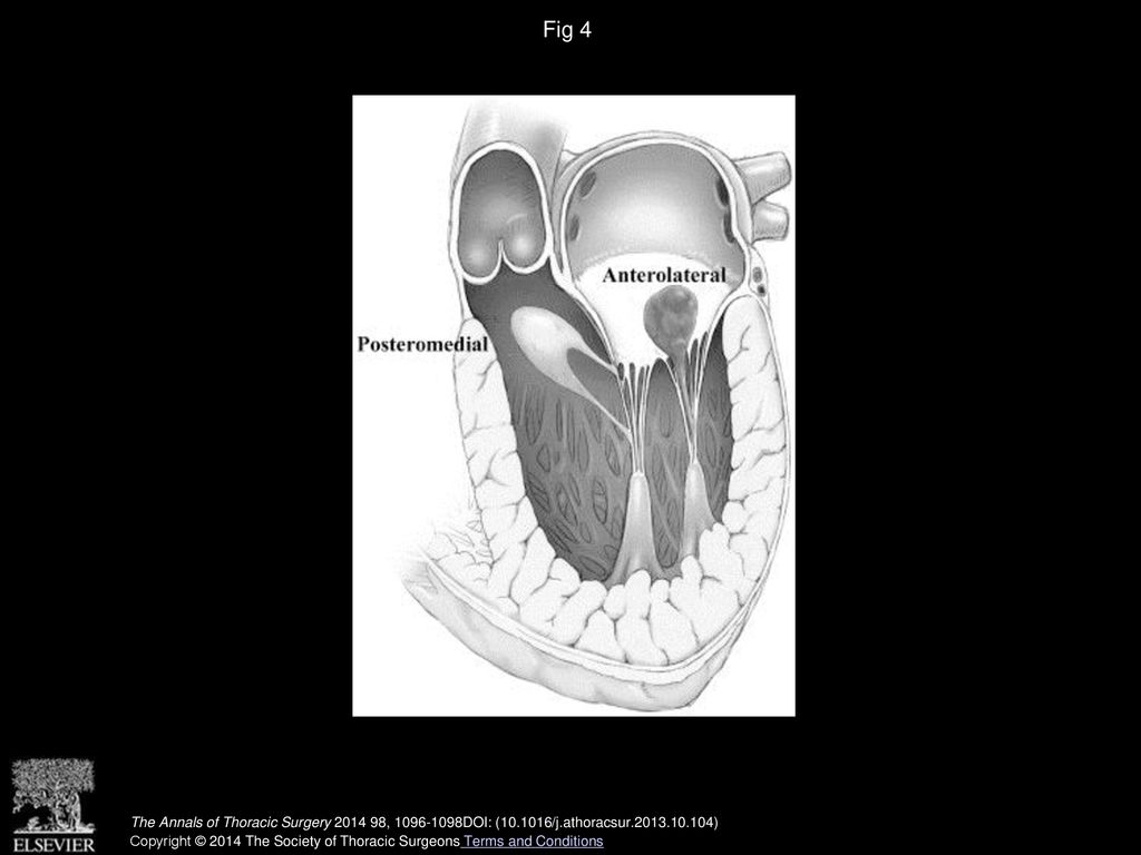 Fig 4 Schematic presentation of the accessory mitral valve tissues, anatomic location related to the left ventricular structures and mitral valve.
