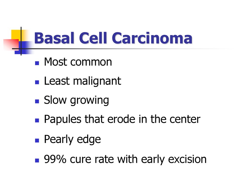 Basal Cell Carcinoma Most common Least malignant Slow growing
