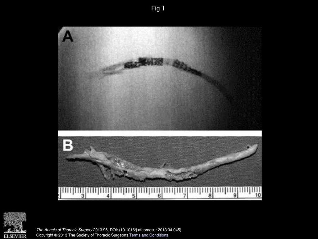 Fig 1 (A) Radiologic image. (B) Endarterectomy specimen, including two stents.