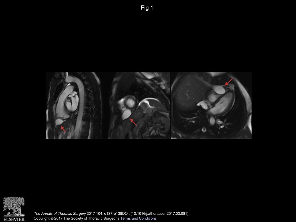 Fig 1 Cardiac magnetic resonance imaging—sagittal, short axis, axial views. Red arrows indicate the cystic mediastinal lesion.