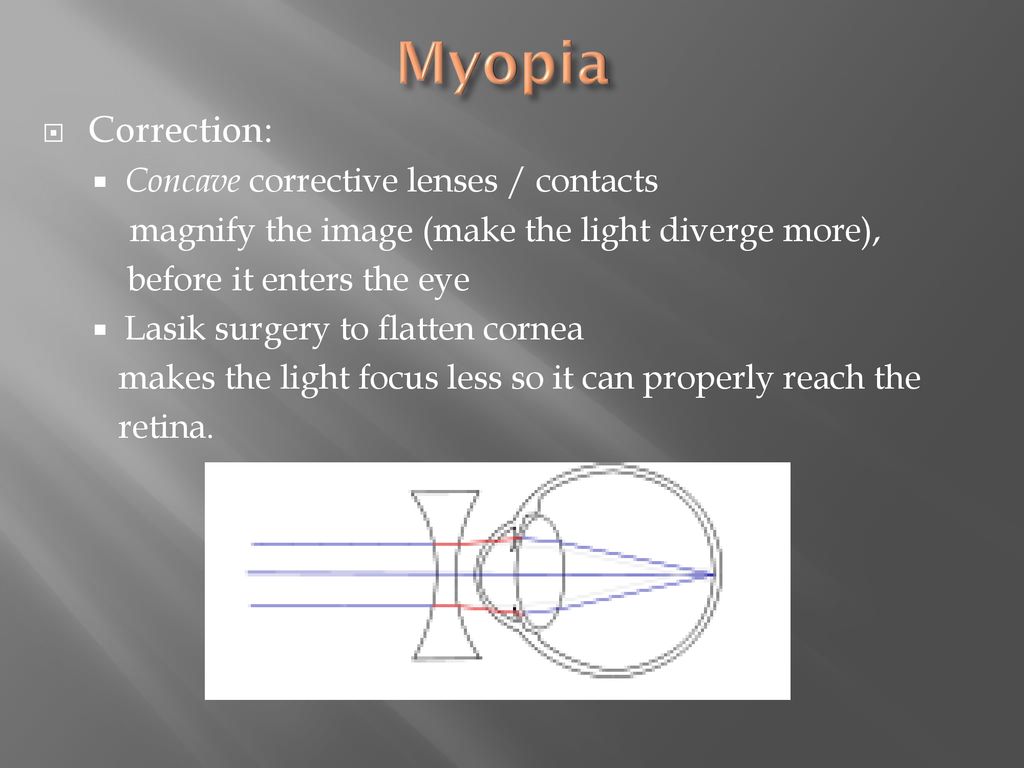 myopia hyperopia and astigmatism ppt cum să restabiliți viziunea 2