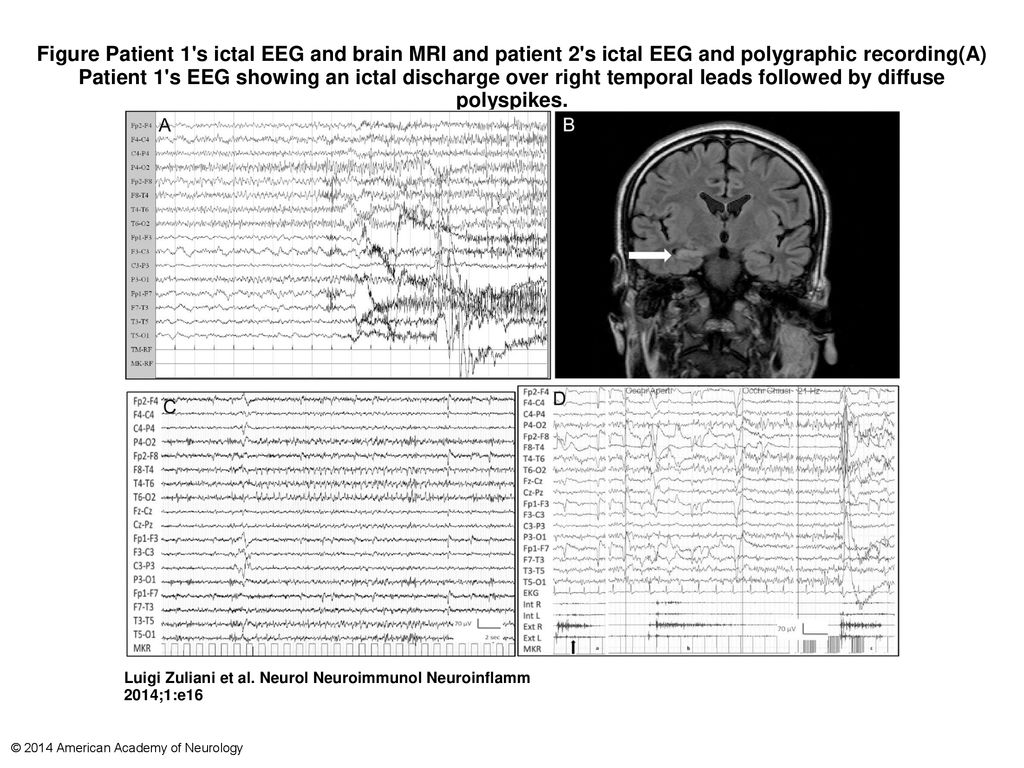 Figure Patient 1's ictal EEG and brain MRI and patient 2's ictal EEG ...