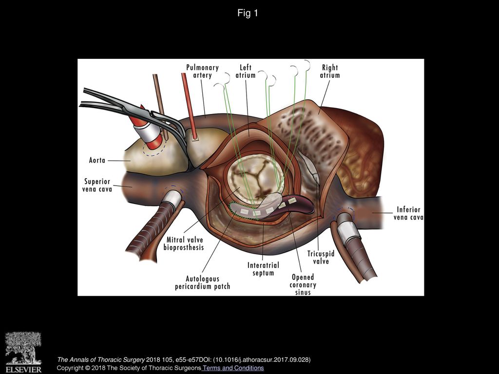 Fig 1 Diagram from a transseptal atrial view showing the mitral valve bioprosthesis anchored to the native uncalcified coronary sinus.