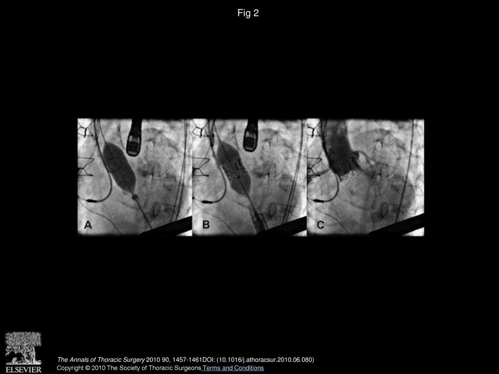 Fig 2 Intraoperative balloon valvuloplasty (A), valve implantation (B), and final angiographic result (C) of porcelain aorta.