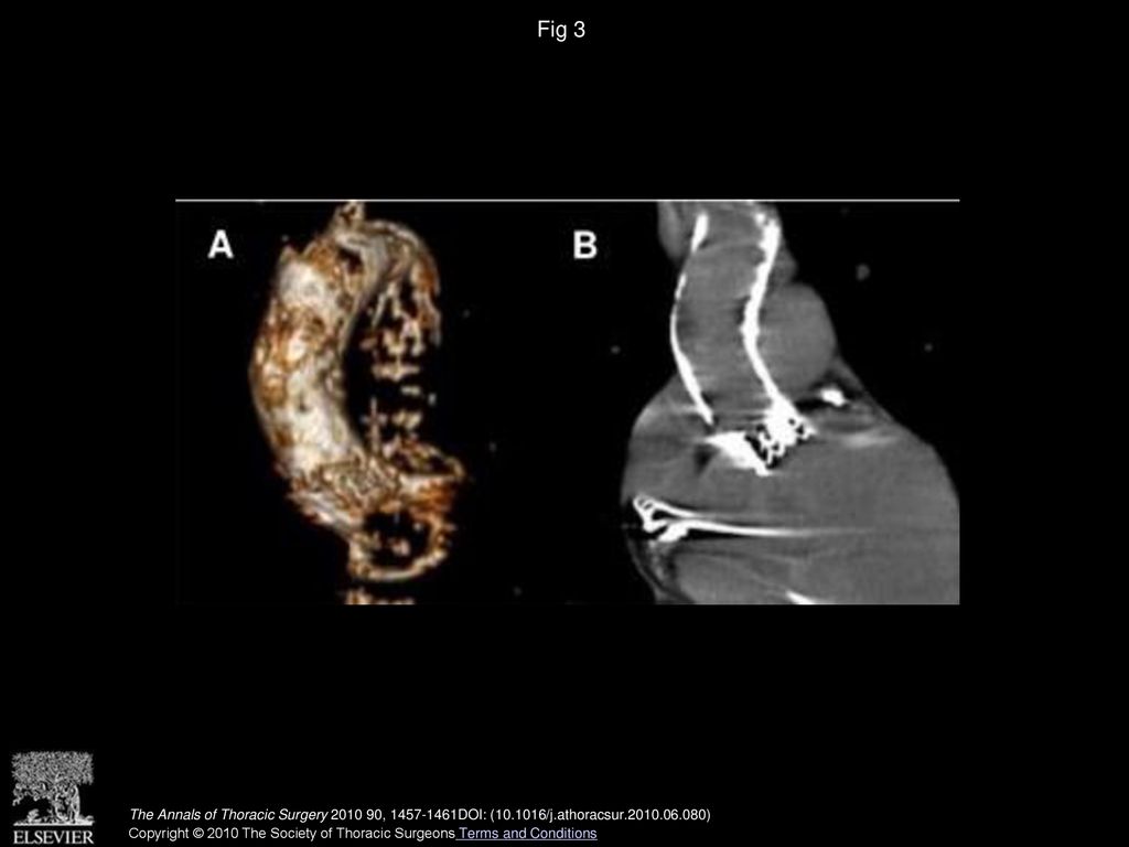 Fig 3 Postoperative three-dimensional reconstruction (A) and computed tomographic scan (B) of porcelain aorta.