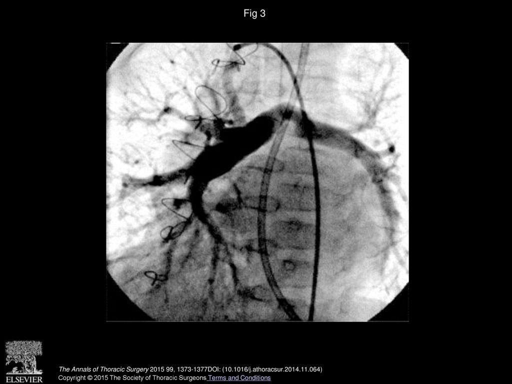 Fig 3 Pulmonary arteriogram shows stenosis of a previously patched left branch pulmonary artery.