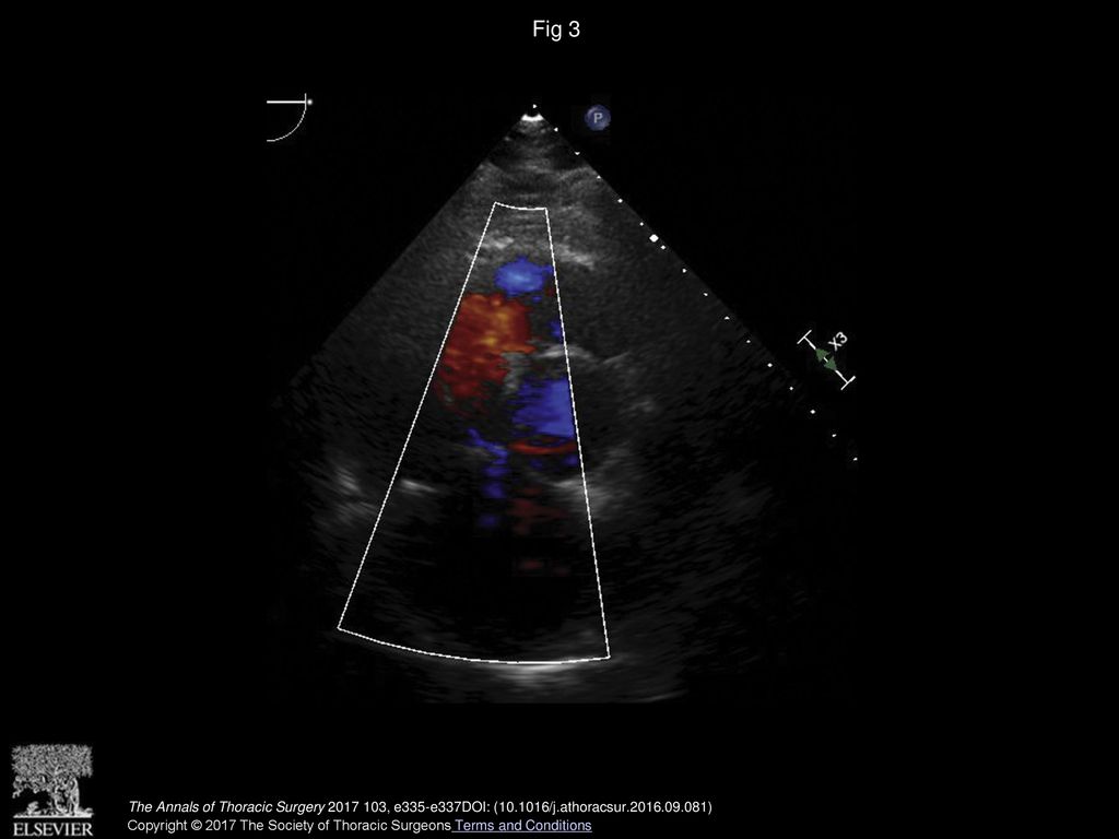 Fig 3 Postoperative transthoracic echocardiography shows no tricuspid regurgitation.