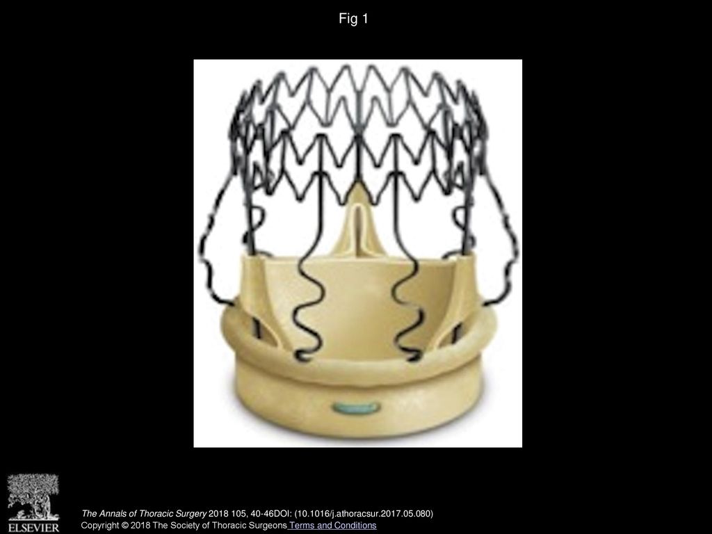 Fig 1 Perceval (LivaNova, Mila, Italy) aortic sutureless bioprosthesis.