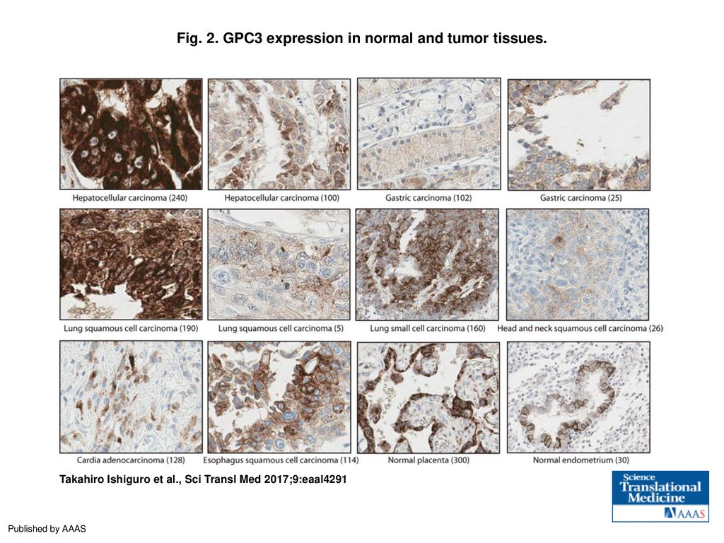 Fig. 2. GPC3 expression in normal and tumor tissues.