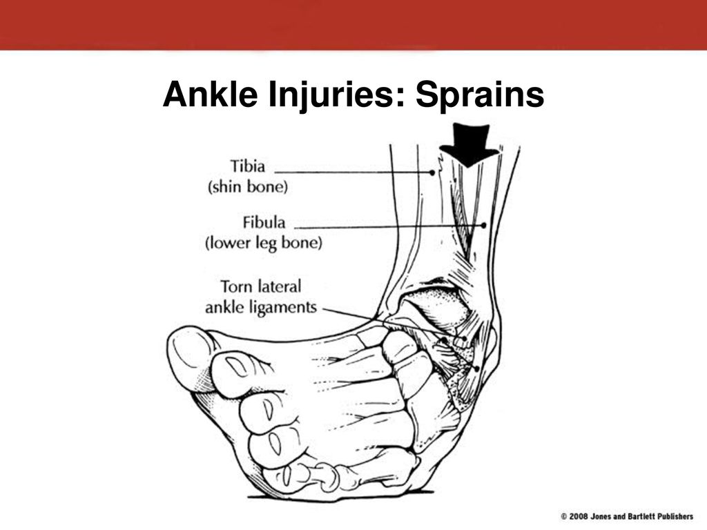 Injuries To The Lower Leg, Ankle, And Foot - Ppt Download