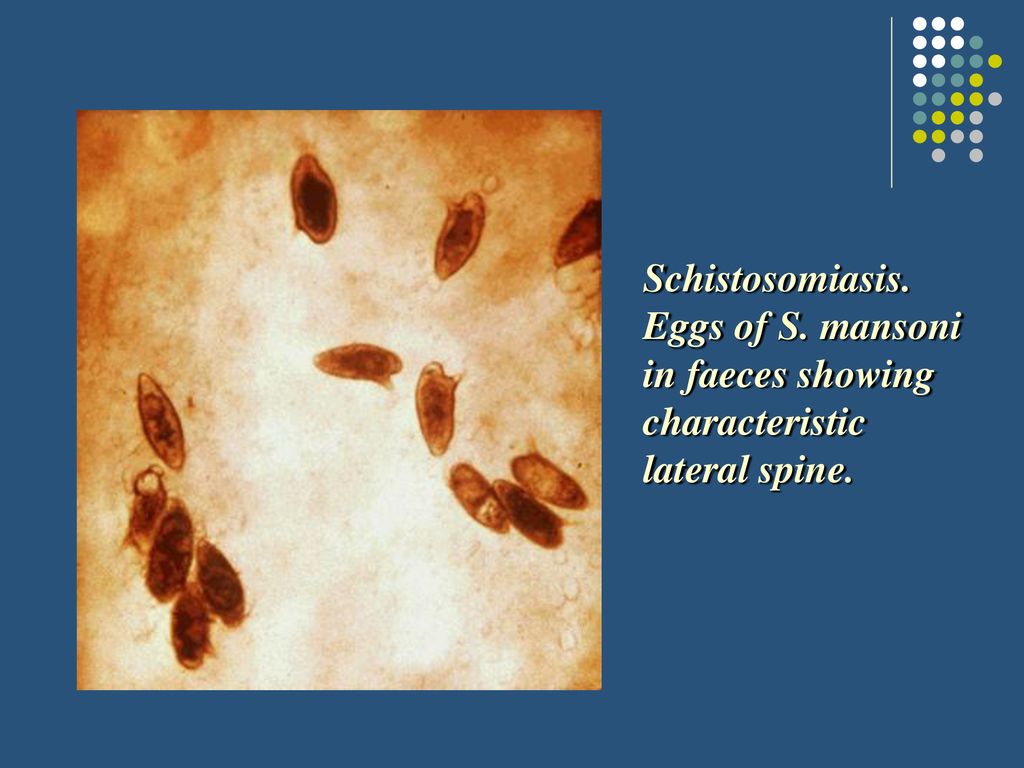 schistosomiasis eggs in stool