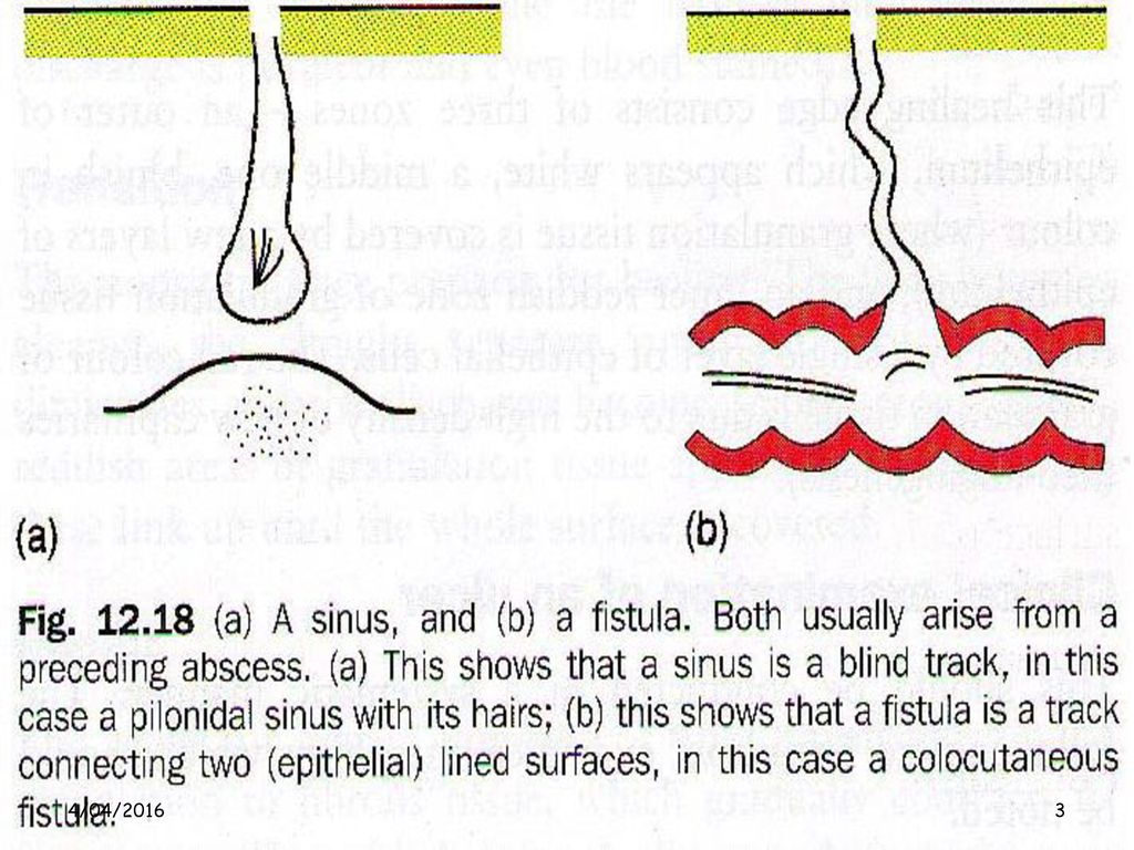 Sinuses A Sinus Is A Blind Tract Usually Lined With Granulation Tissue That Leads From An Epithelial Surface Into The Surrounding Tissue E G Pilonidal Ppt Download Sinuses A Sinus Is A Blind Tract Usually Lined With Granulation Tissue That Leads From An Epithelial Surface Into The Surrounding Tissue E G Pilonidal Ppt Download
