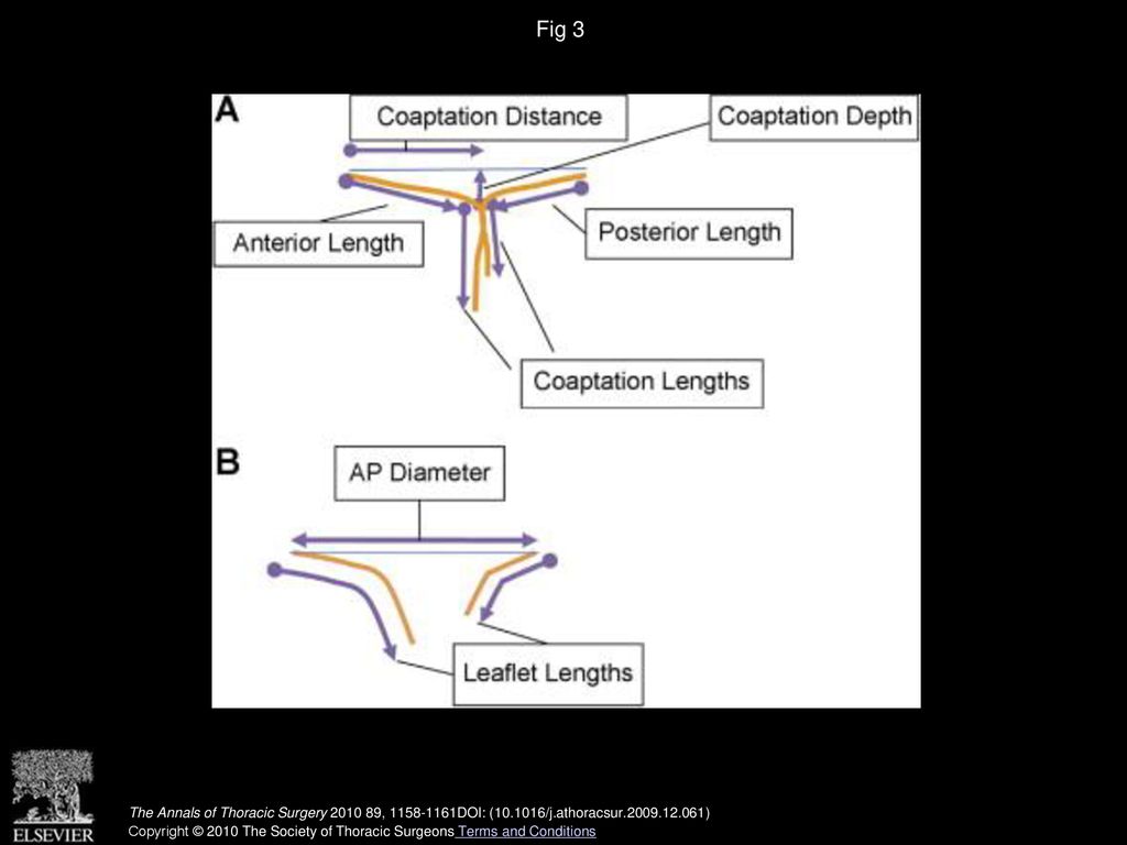 Fig 3 Schematic of leaflet measurements in deep systole (A) and diastole (B). (AP = anterior-posterior.)
