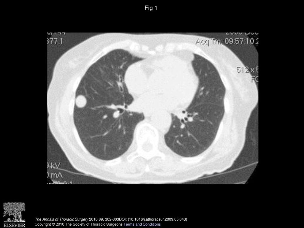 Fig 1 Computed tomographic scan showing a 2-cm round nodule in the right lower lung.