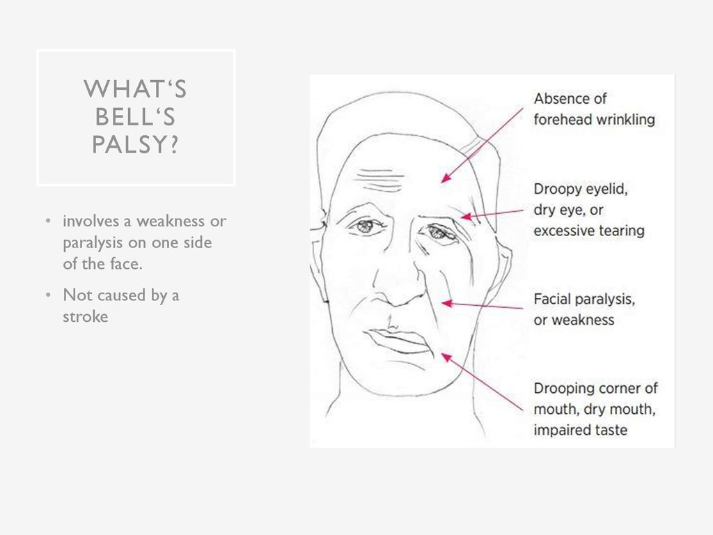 What‘s Bell‘s Palsy. involves a weakness or paralysis on one side of the face.