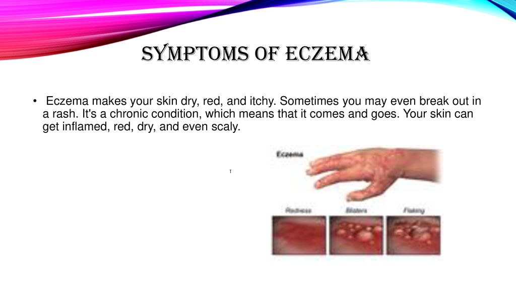 Eczema Written by: Katie Dalrymple Written on November 3, ppt download