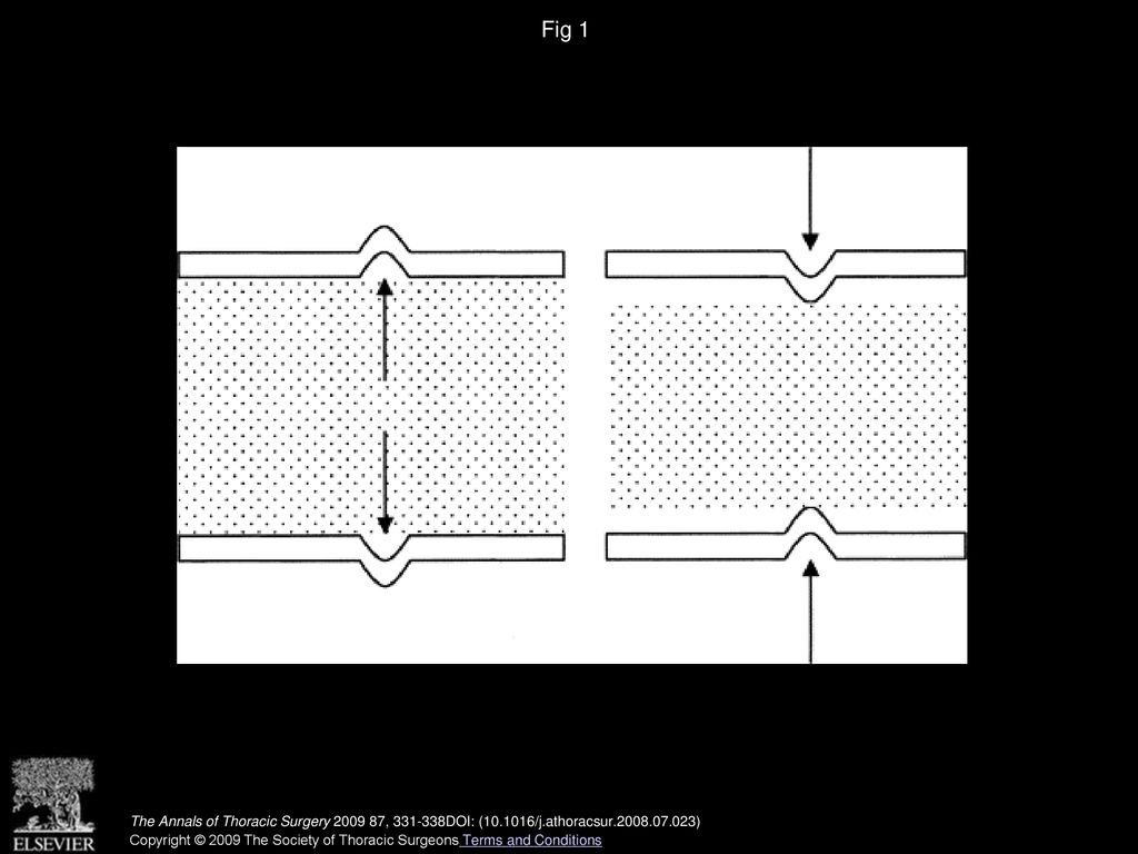 Fig 1 (Left) Internal wall stress and (right) external wall stress causing deformation.