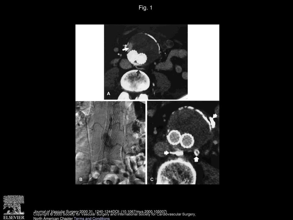 Retroperitoneal endoscopic ligation of lumbar and inferior mesenteric ...