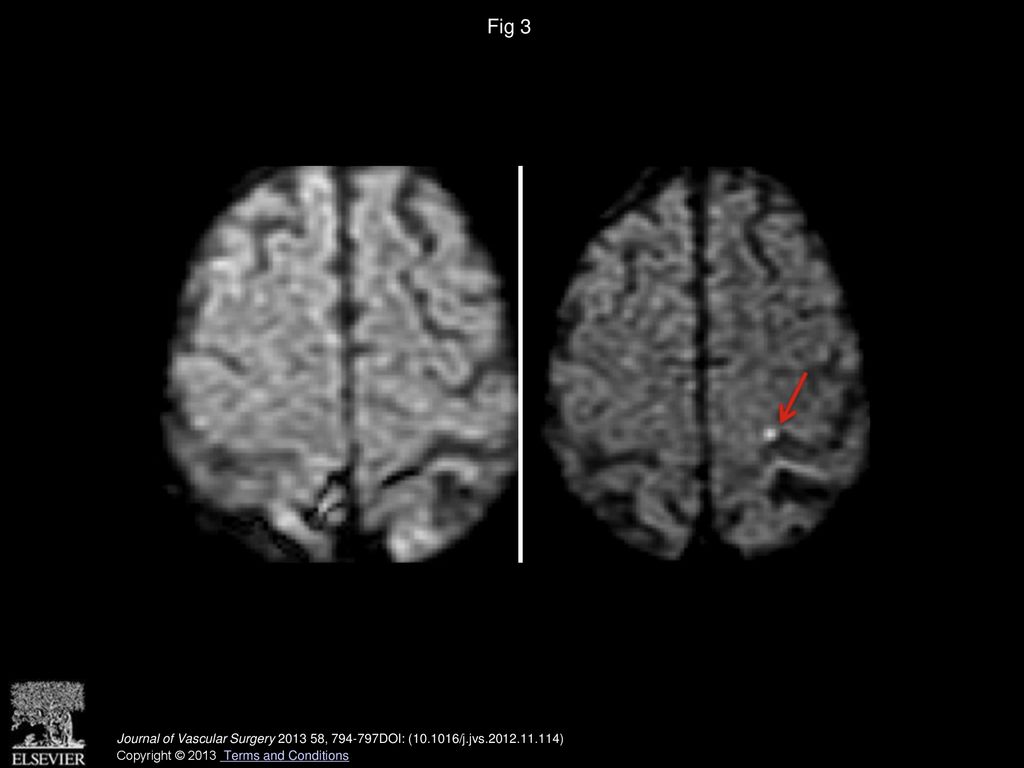 Fig 3 Pre- and postprocedure diffusion-weighted magnetic resonance imaging (DWI) demonstrating a new lesion.