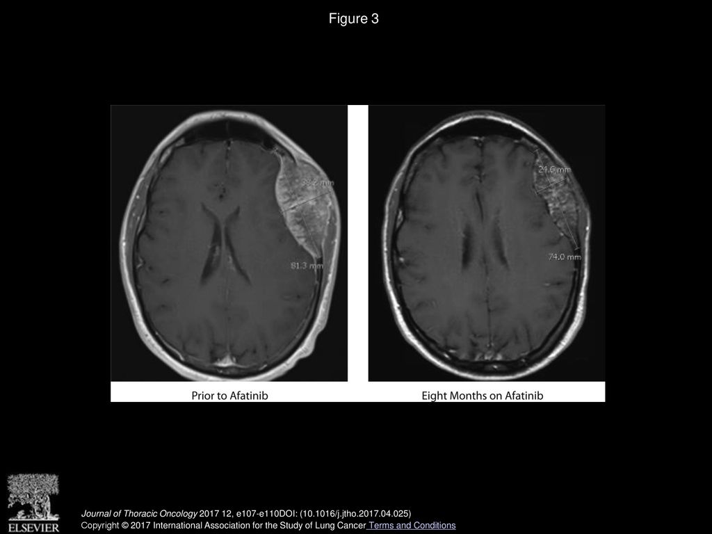 Durable Response to Afatinib in Lung Adenocarcinoma Harboring NRG1 Gene ...