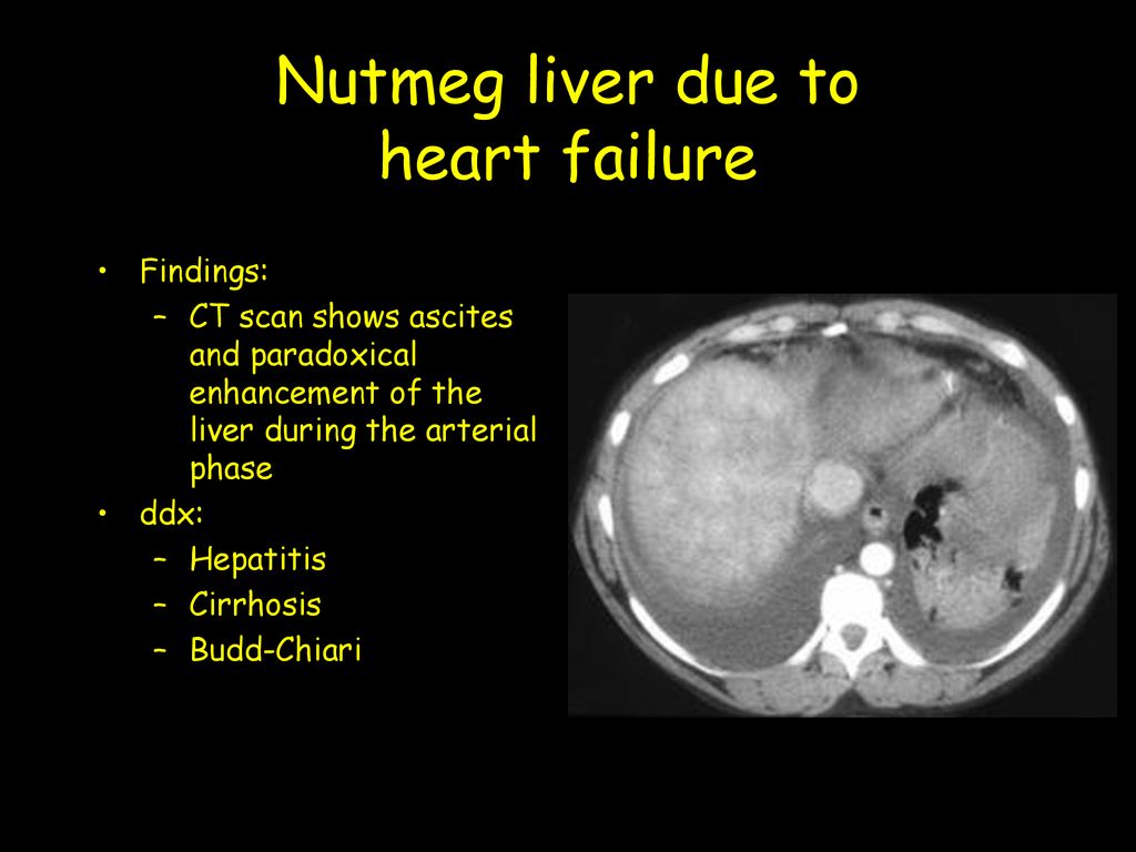 Nutmeg Liver Ultrasound