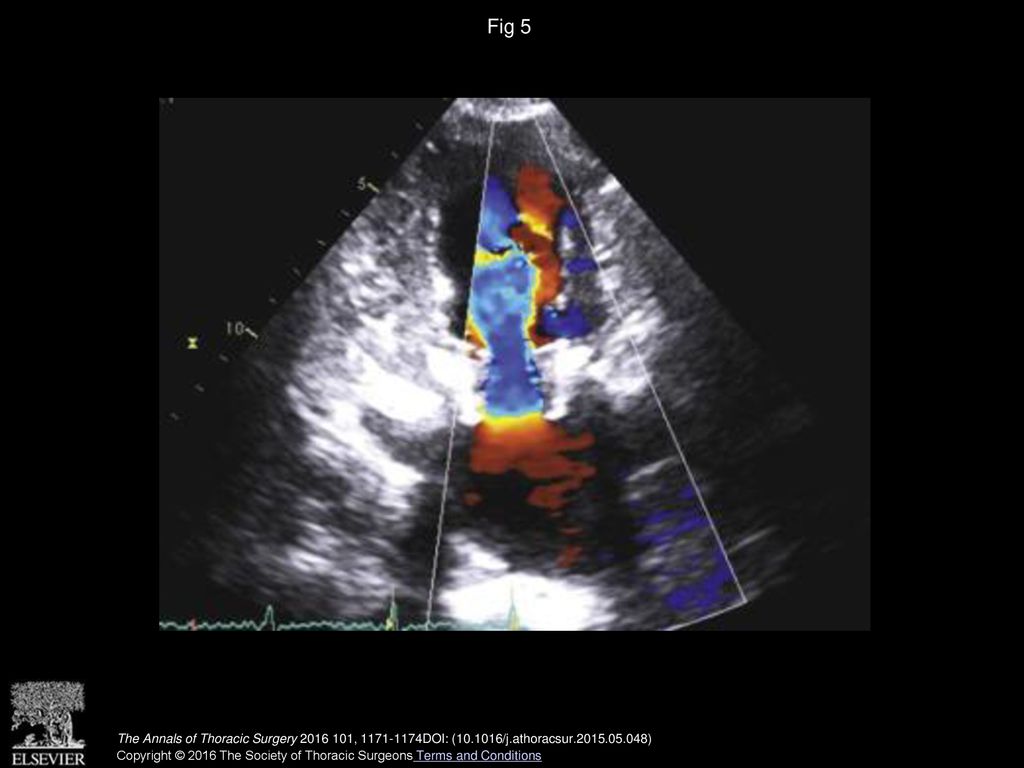Fig 5 Postoperative transthoracic echocardiography showed only trivial mitral valve periprosthetic regurgitation.