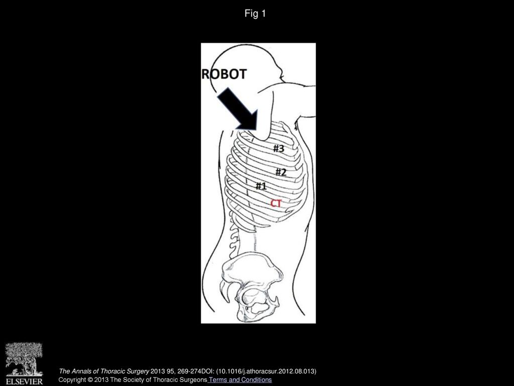 Fig 1 Numbers 1, 2, and 3 indicate incisions for port placement and robot positioning. CT indicates incision 4 for the chest tube.