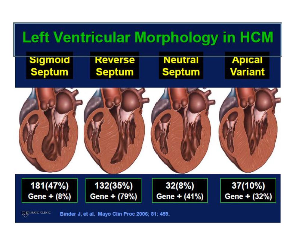 Hypertrophic cardiomyopathy ppt download